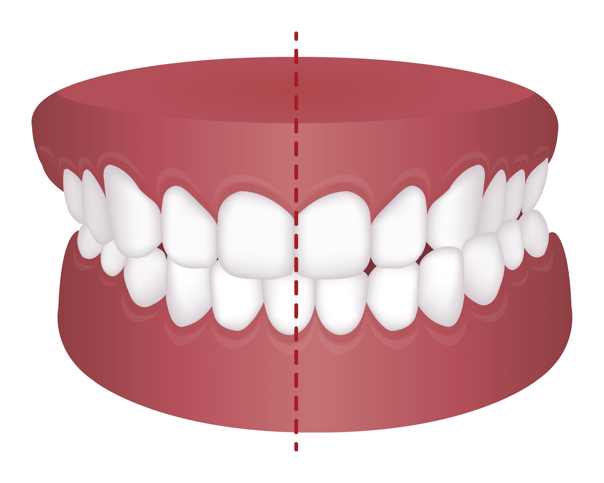 Bite-Balancing-teeth-alignment