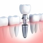 Dental-Implant-Beverly-Hills