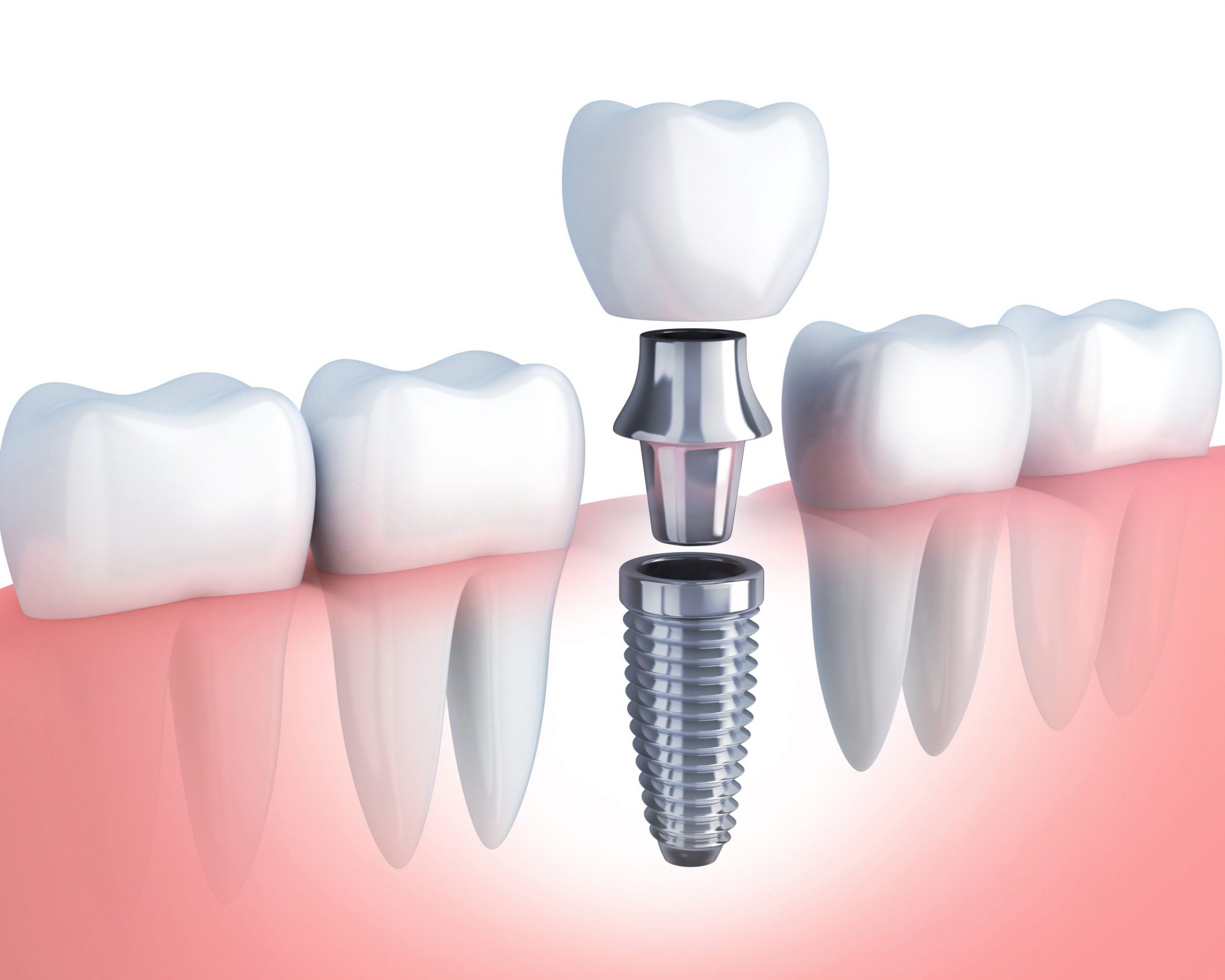 Dental-Implant-Beverly-Hills