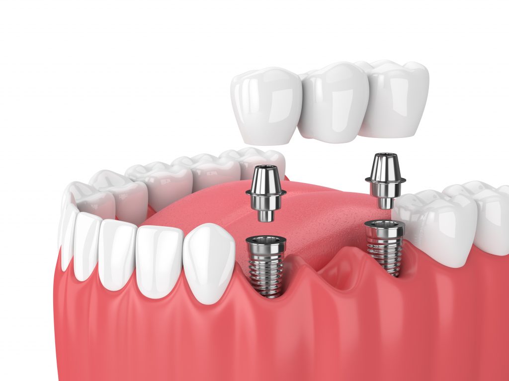 Restorative-Dentistry-implant-bridge