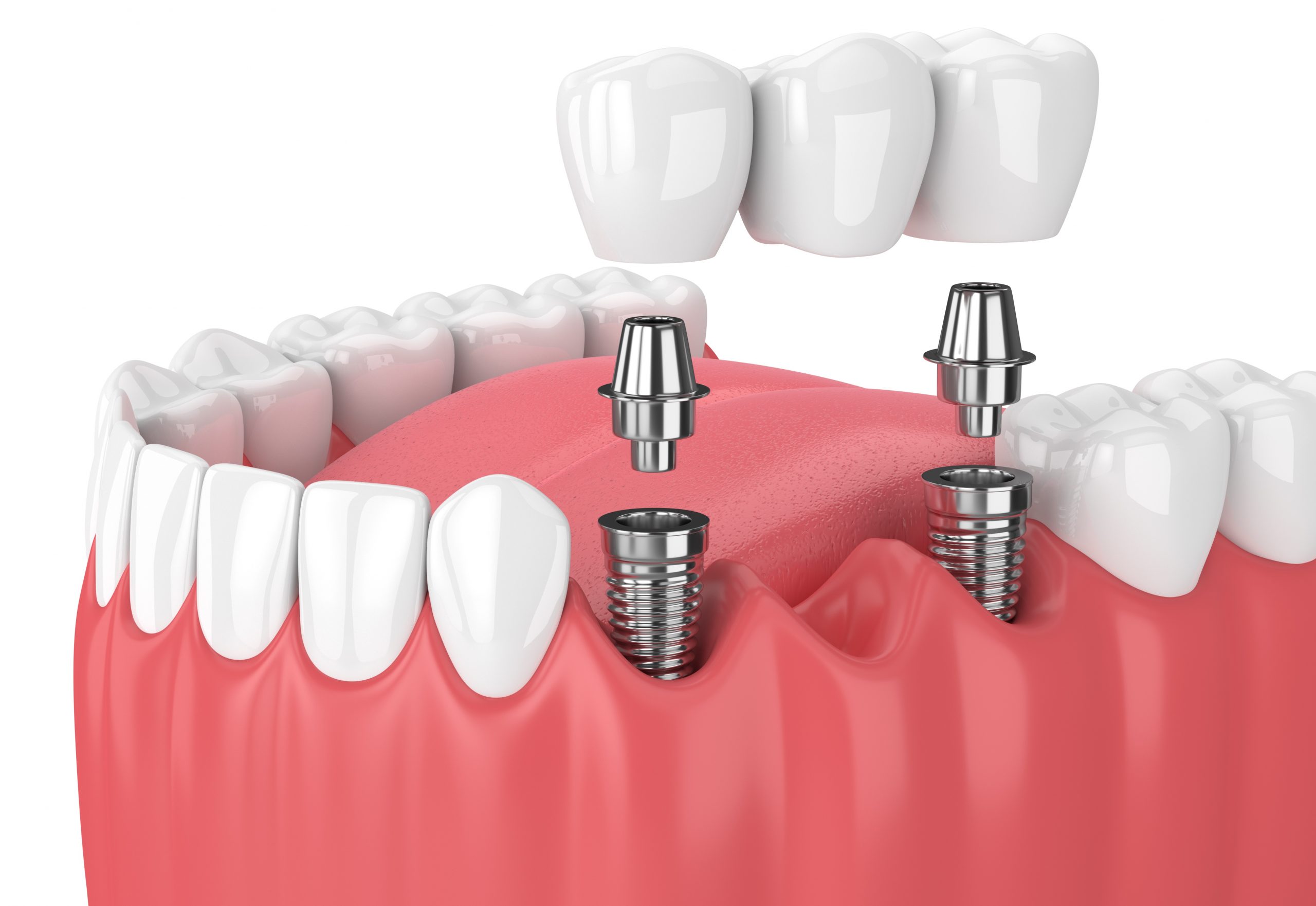 implant-based-bridge