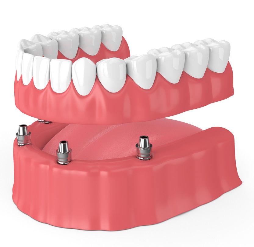 implant-supported-denture