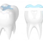 inlay-onlay-teeth